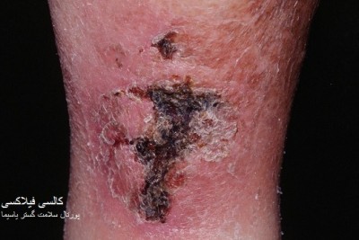 عکس کلسیفیلاکسی Calciphylaxis