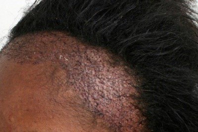 عل ایجاد ریزش موی کششی (Traction Alopecia) و درمان آن