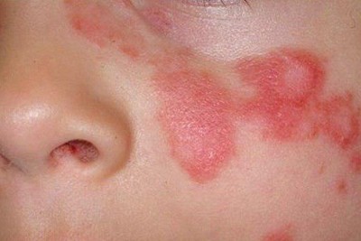 آشنایی با بیماری لوپوس اریتماتوز جلدی (Discoid Lupus Erythematosus) 