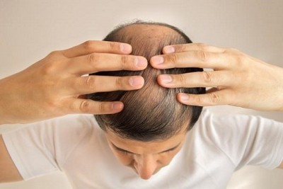 درمان ریزش موی مردانه و چرب شدن موها چیست؟