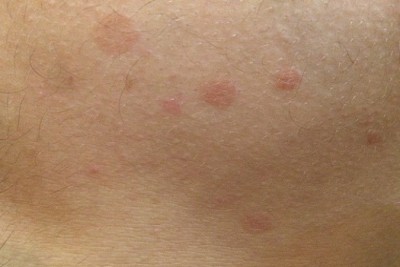 لکه های قرمز روی بدنم نشانه چیست؟
