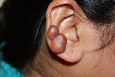 درمان کلوئید گوش 