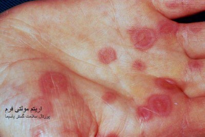 بیماری اريتم مولتی فرم (Erythema multiforme)