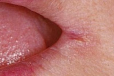 درباره ترک خوردگی گوشه لب (Angular cheilitis) بیشتر بدانیم 