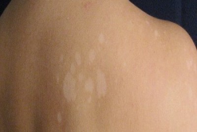 علت خارش  و ایجاد لکه های سفید رنگ بر روی کمر من چه میتواند باشد؟