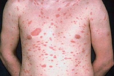 پیتیریازیس روزه آ (Pityriasis Rosea)