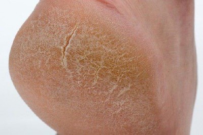 ترک خوردگی پاشنه پا (Cracked heels) و راههای درمان آن