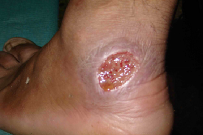 سالک   Leishmaniasis