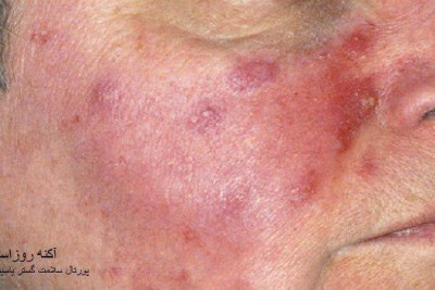 عکس آکنه روزاسه(Acne Rosacea)