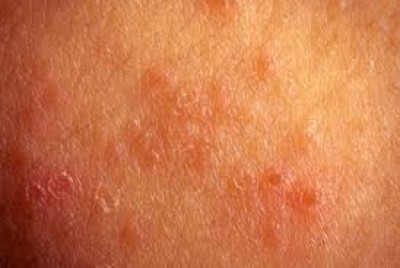 اگزما (حساسیت پوستی) چیست و چگونه ایجاد می شود؟