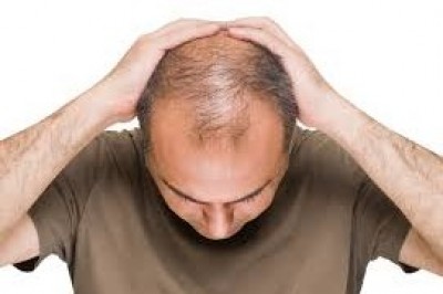 آیا ماینوکسیدیل ریزش موها را تشدید میکند؟