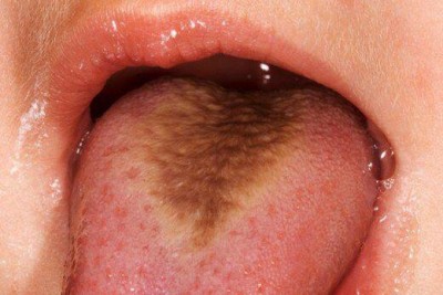 درمورد زبان مودار(Hairy tongue) چه می دانید؟