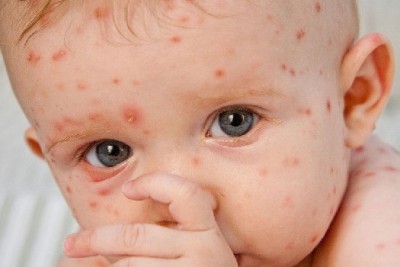 آبله مرغان (Chickenpox)