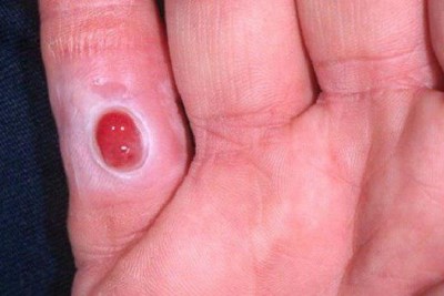 گرانولوم پیوژنیک (Pyogenic granuloma)