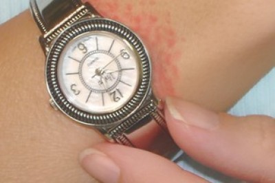 عکس حساسیت به نیکل با ساعت