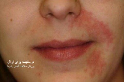 اگزمای اطراف دهان (Perioral Dermatitis)