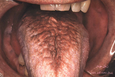 عکس زبان مودار (Hairy Tongue)