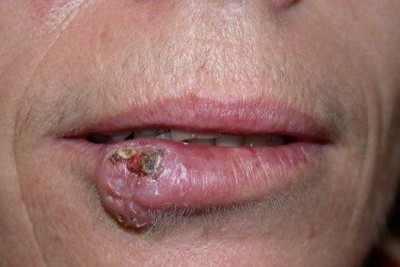  سرطان  سلول های سنگفرشی پوست (Squamous cell carcinoma)