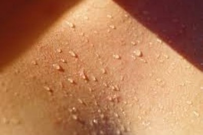 تعریق بیش از حد (Hyperhidrosis) و راههای درمان