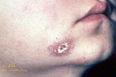 بیماری سل پوستی (skin tuberculosis)