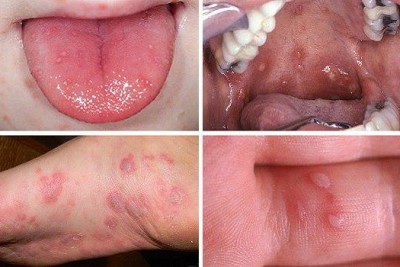 بیماری دست، پا و دهان (Hand, foot and mouth disease)