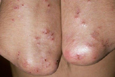درماتیت هرپتی فرم (Dermatitis Herpetiformis)