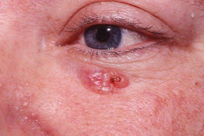 سرطان سلول های قاعده ای پوست (Basal Cell Carcinoma)