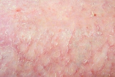 درمان حساسیت به پد های پوستی چیست؟