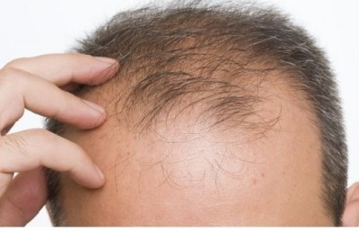 درمان ریزش مو و شوره سر چیست؟