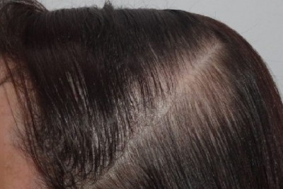 علت ریزش و نازک شدن موهایم چیست و چه روش درمانی برای آن وجود دارد؟