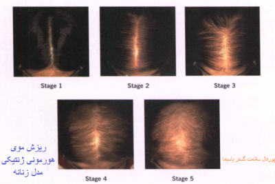 عکس ریزش موی هورمونی ژنتیکی مدل زنانه
