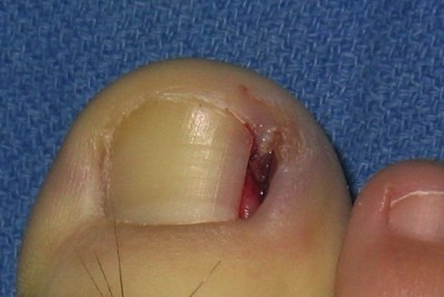 ناخن فرورفته در گوشت (ingrowing toe nail) 