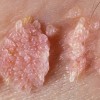 زگیل تناسلی (genital wart) و راههای درمان آن