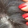 راه درمان ریزش مو و شوره سر چیست؟