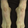 آیا درمانی برای پینه قوزک پا وجود دارد؟