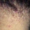 پشت گردنم دچار آکنه کلوییدالیس شده است. آیا راه درمانی دارد؟