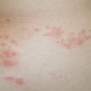 هر آنچه درباره بیماری پوستی  زونا (shingles) باید بدانیم