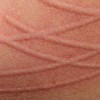 علل کهیر فیزیکی  و درمان آن