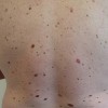 چه نوع خالهای رنگی (ملانوسيتی) را بايد جدی گرفت و جهت تشخيص دقيق تر به متخصص پوست مراجعه نمود؟   
