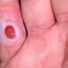 گرانولوم پیوژنیک (Pyogenic granuloma)