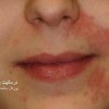 اگزمای اطراف دهان (Perioral Dermatitis)