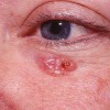 سرطان سلول های قاعده ای پوست (Basal Cell Carcinoma)