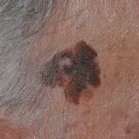 کراتوز سبورئیک (Seborrheic Keratosis) 