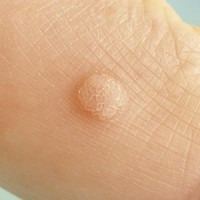 آیا ویروس زگیل قابل انتقال است؟
