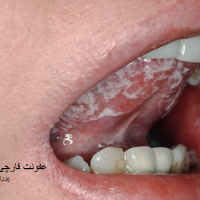 کاندیدیاز دهانی