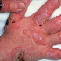اپیدرمولیزیس بولوزا (Epidermolysis Bullosa) یا بیماری پروانه ای
