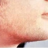 علت بروز هيرسوتيسم (پرموئي تيپ مردانه) در خانم ها چيست؟   