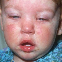 سرخک (Measles)