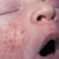 بیماریهای ایجاد کننده جوش های قرمز و چرکی در نوزادان