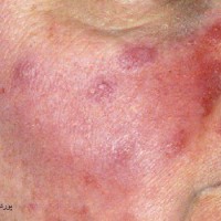 آیا امکان حساسیت به کرم های  مغذی وجود دارد؟